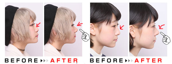 鼻プチ　ノーズシークレット　使用前・使用後画像